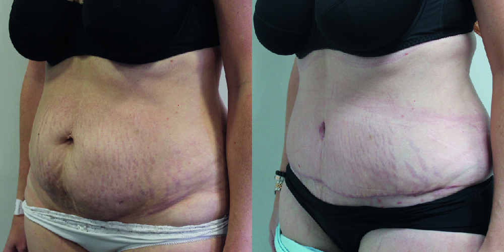 Tummy Tuck Before & After Image