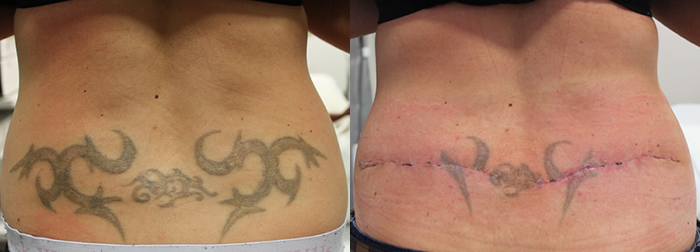 Tattoo Excision Before & After Image