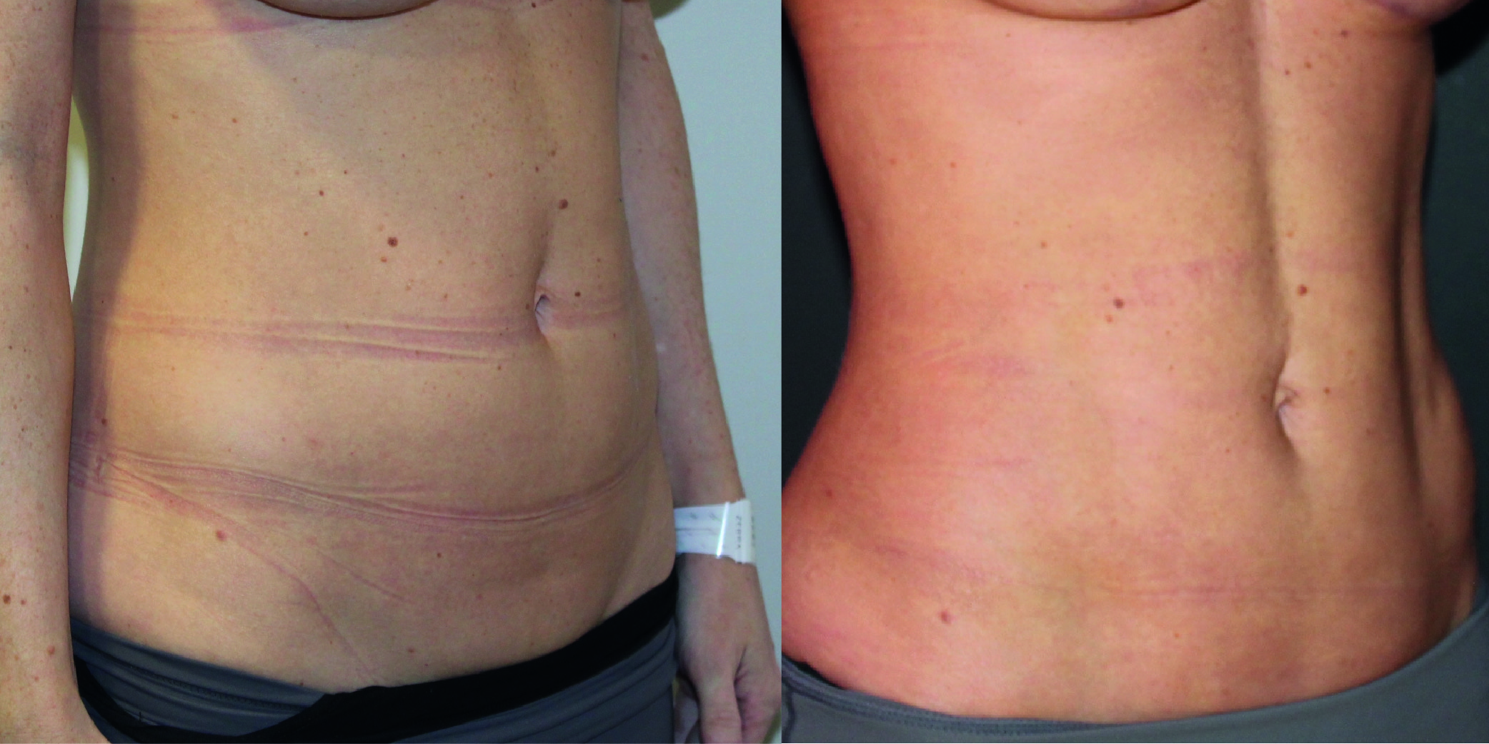 Vaser Before & After Image