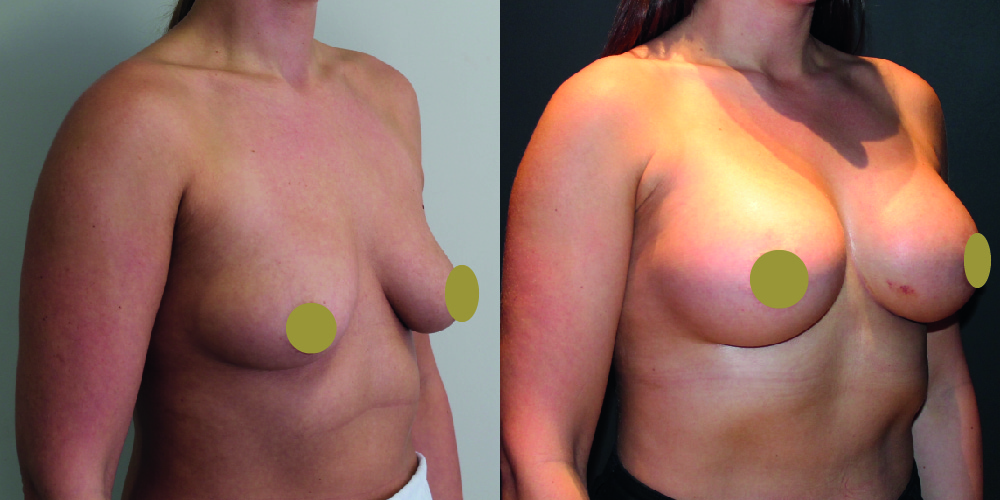 Breast Augmentation Before & After Image