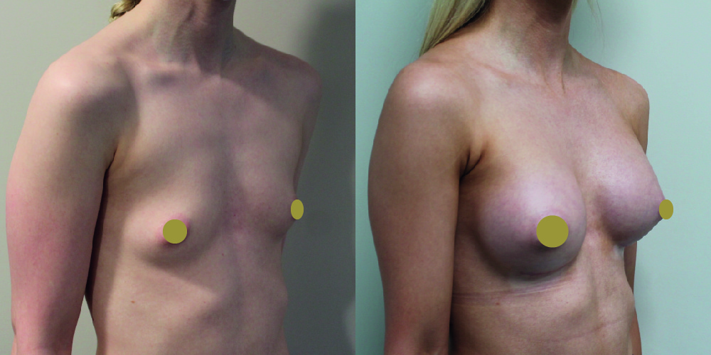 Breast Augmentation Before & After Image