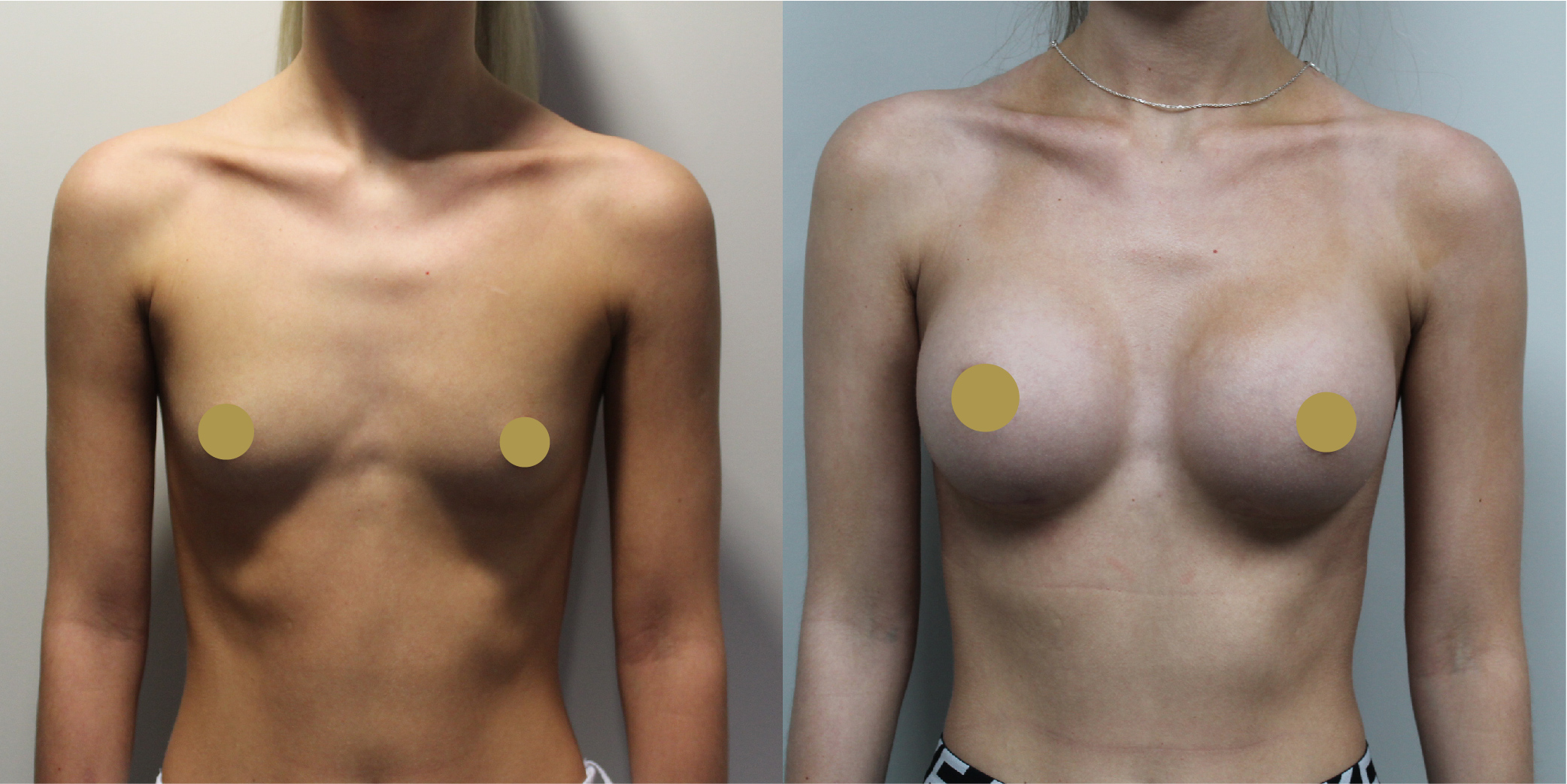 Breast Augmentation Before & After Image