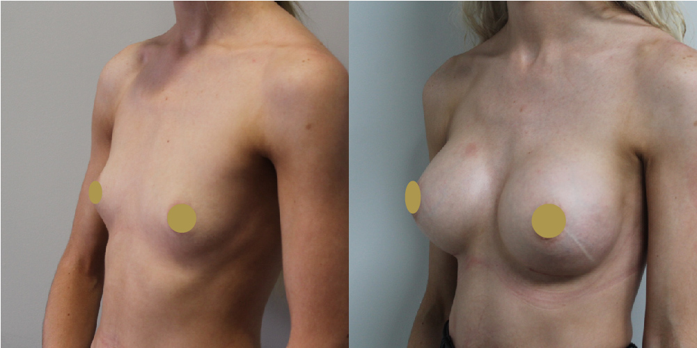 Breast Augmentation Before & After Image