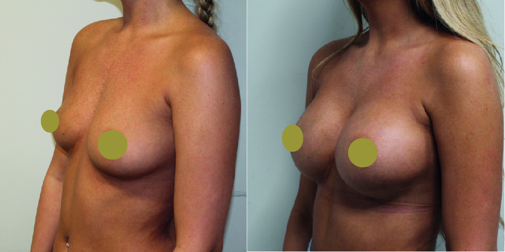 Breast Augmentation Before & After Image