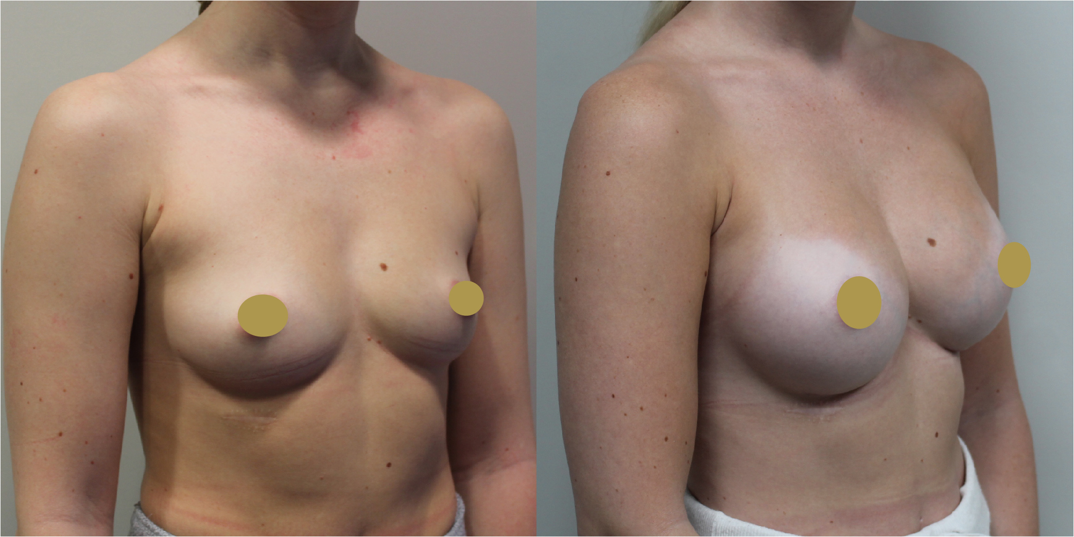 Breast Augmentation Before & After Image