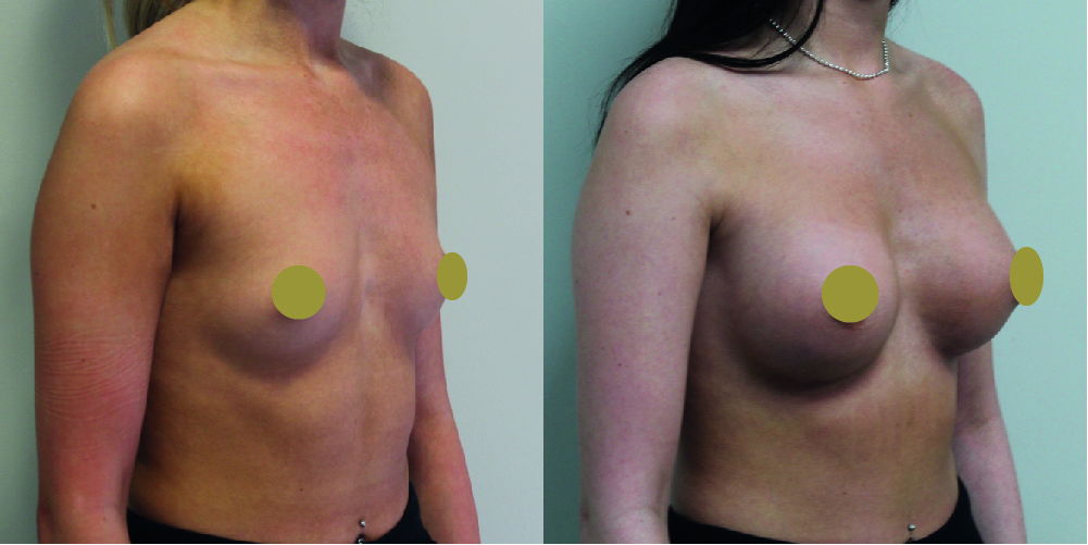 Breast Augmentation Before & After Image