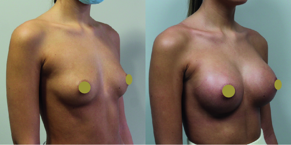 Breast Augmentation Before & After Image