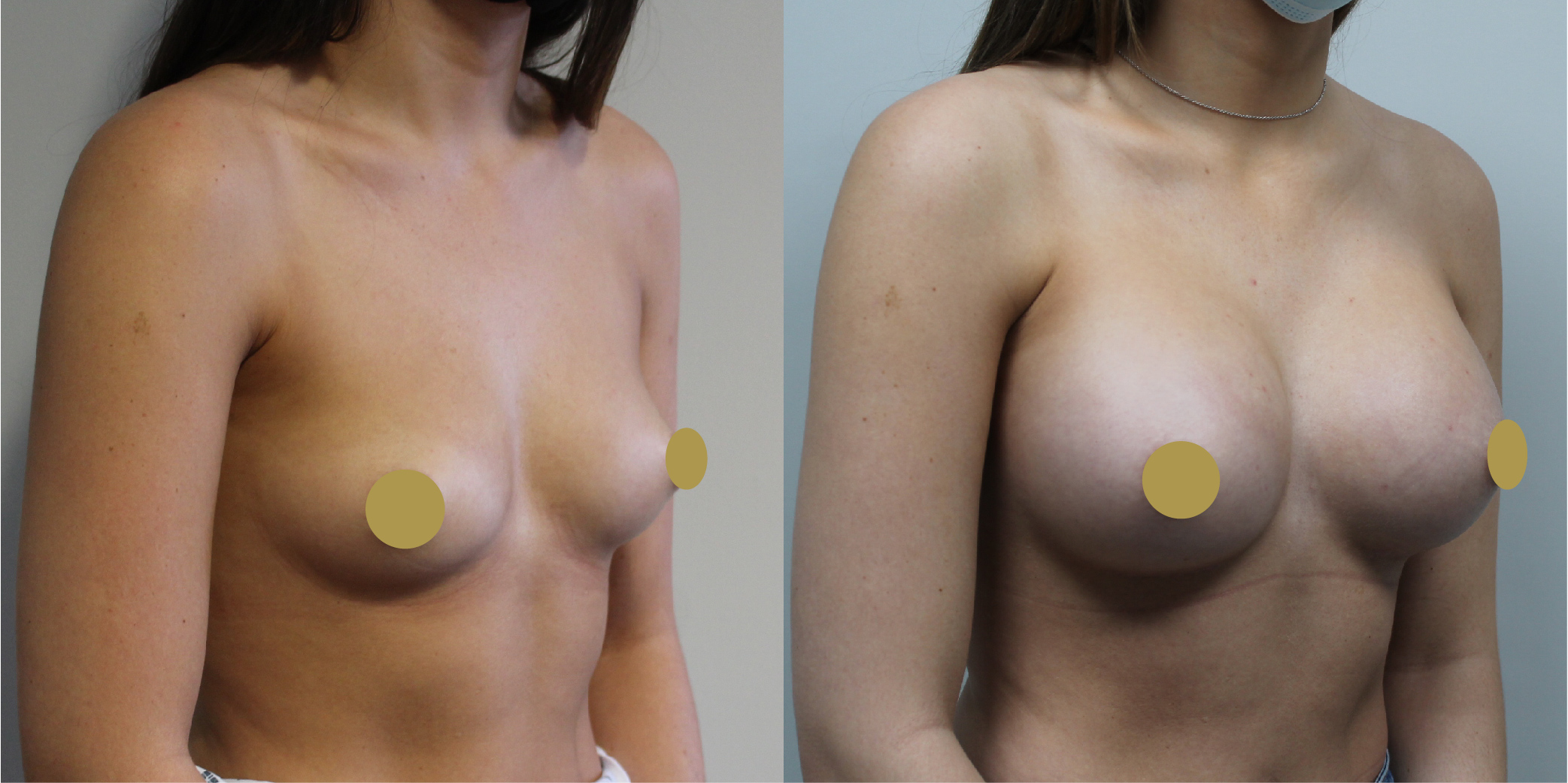 Breast Augmentation Before & After Image