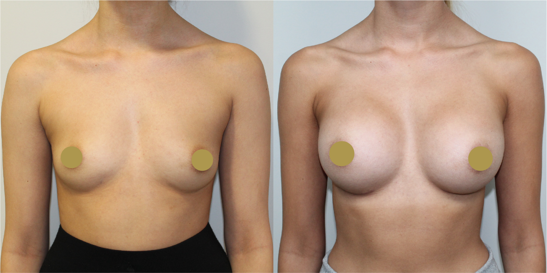 Breast Augmentation Before & After Image