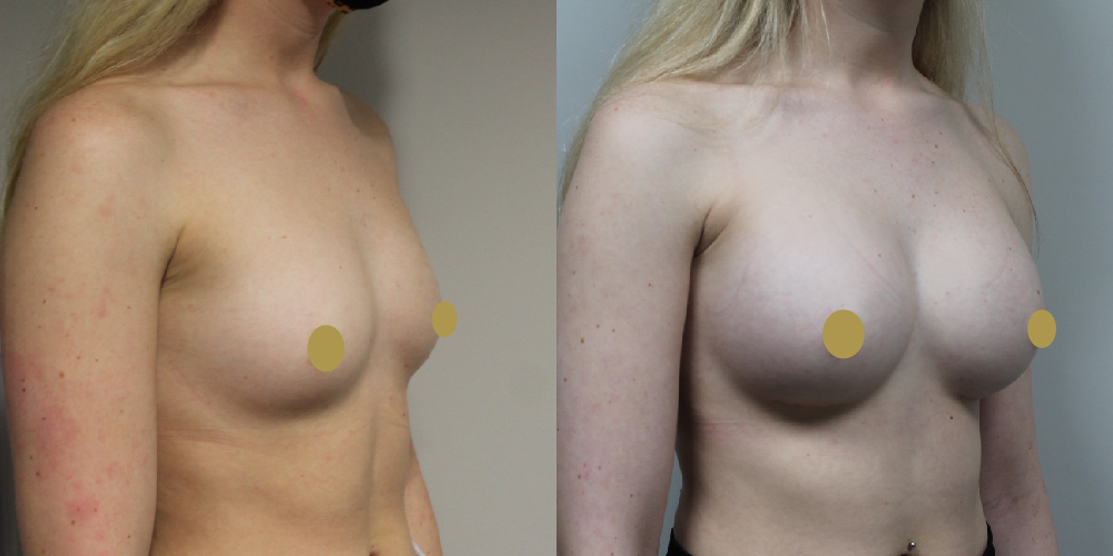 Breast Augmentation Before & After Image