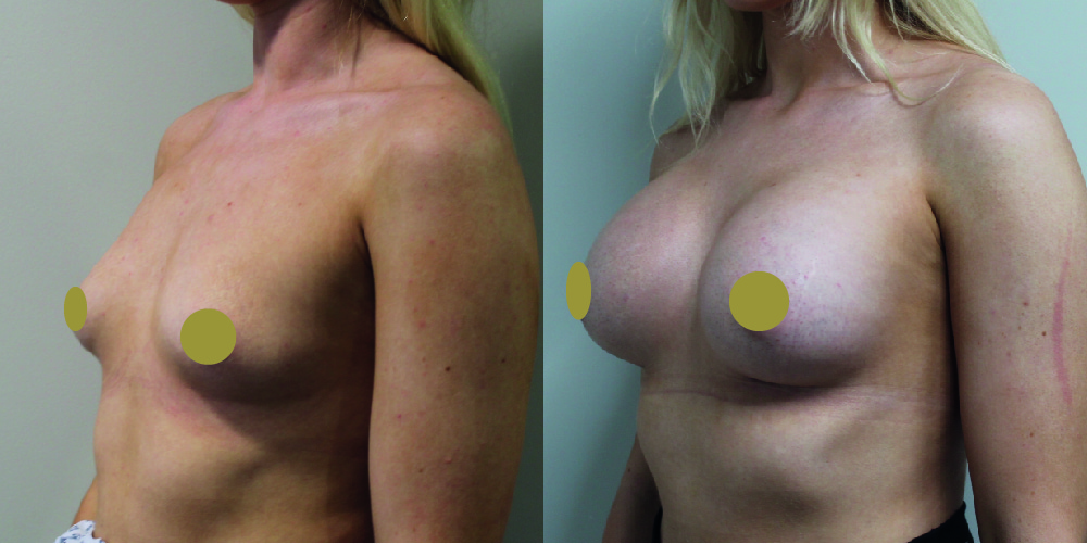 Breast Augmentation Before & After Image