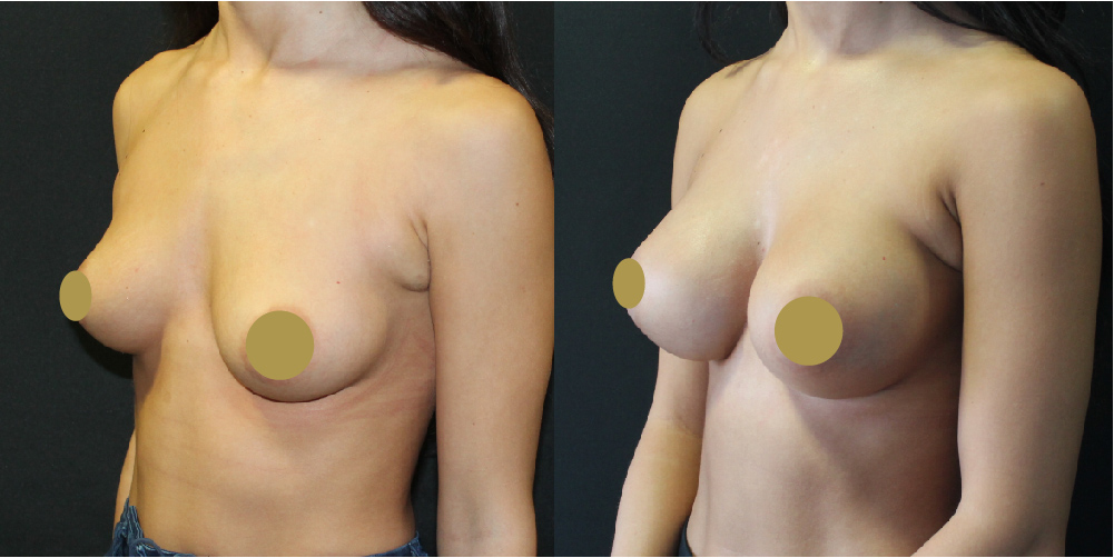 Breast Augmentation Before & After Image