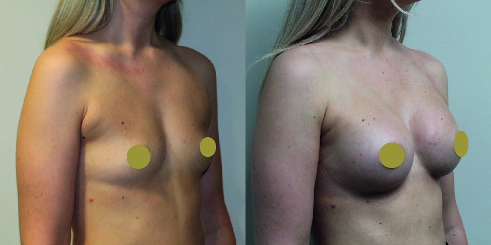 Breast Augmentation Before & After Image