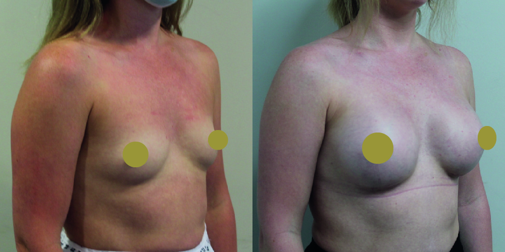 Breast Augmentation Before & After Image