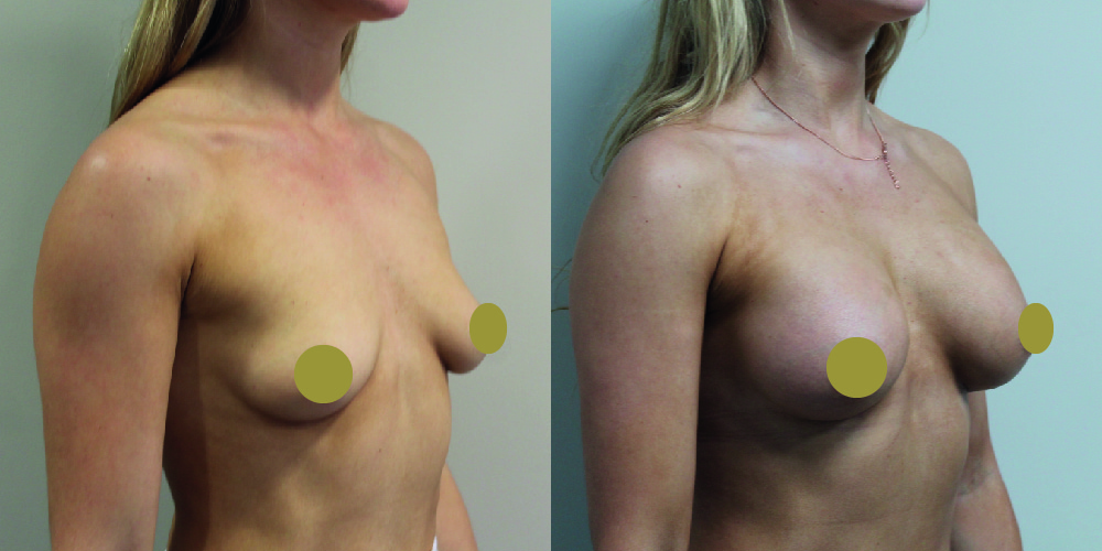 Breast Augmentation Before & After Image