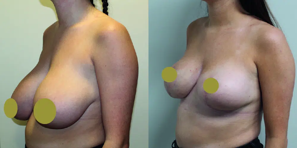 Breast Reduction Before & After Image