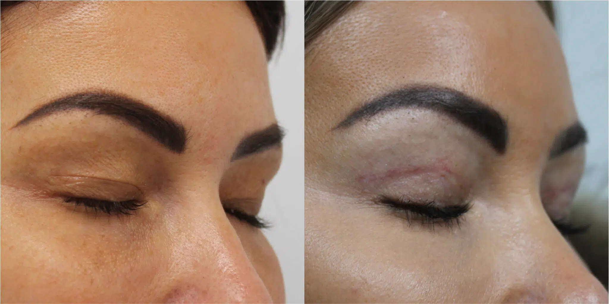 Blepharoplasty Before & After Image