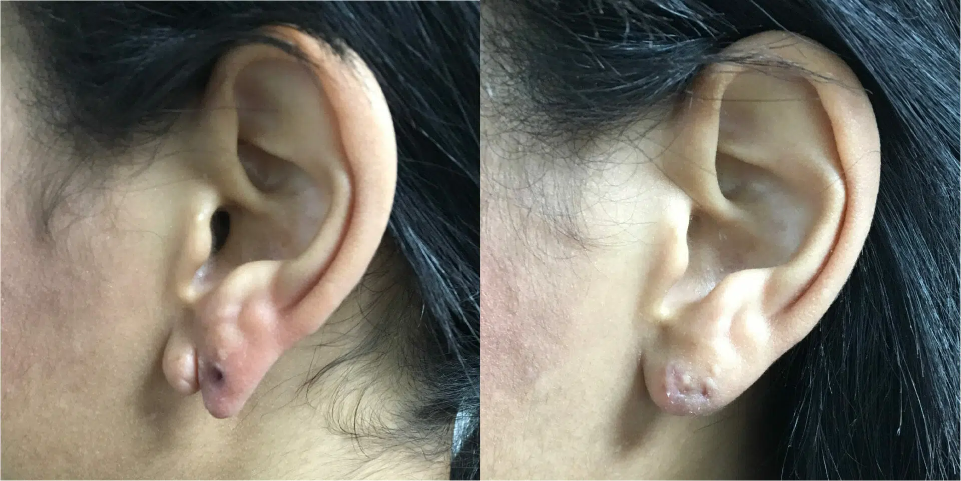 Split Earlobe Repair Before & After Image