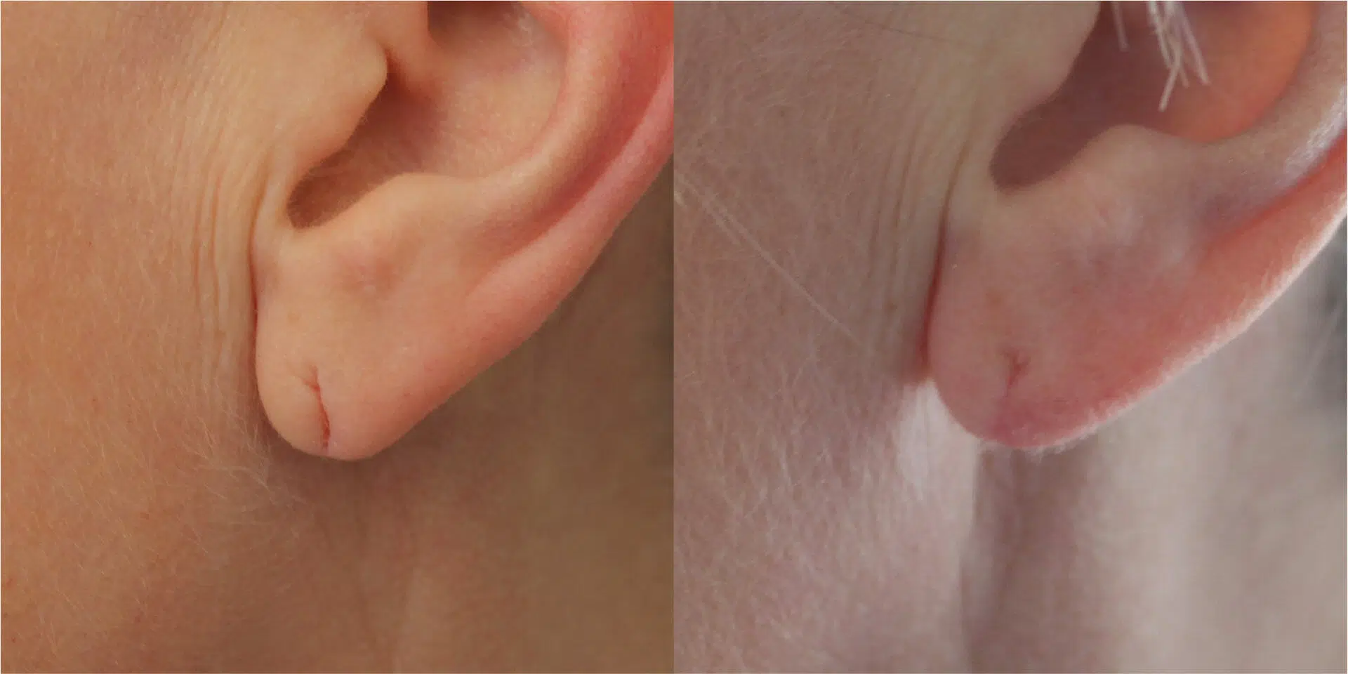 Split Earlobe Repair Before & After Image