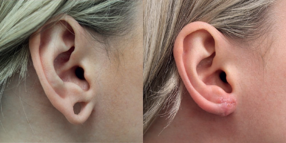 Stretched Earlobe Repair Before & After Image