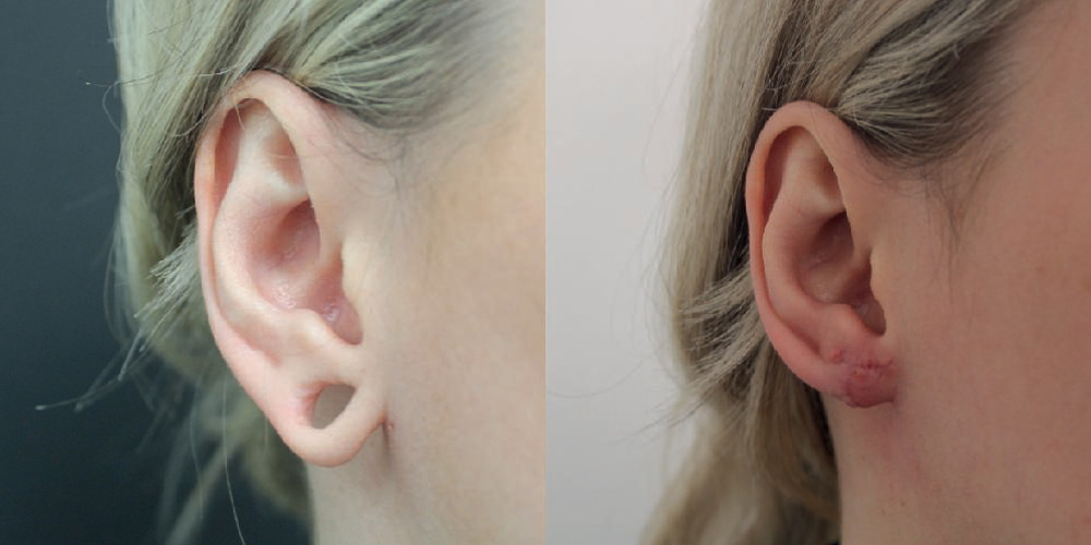 Stretched Earlobe Repair Before & After Image