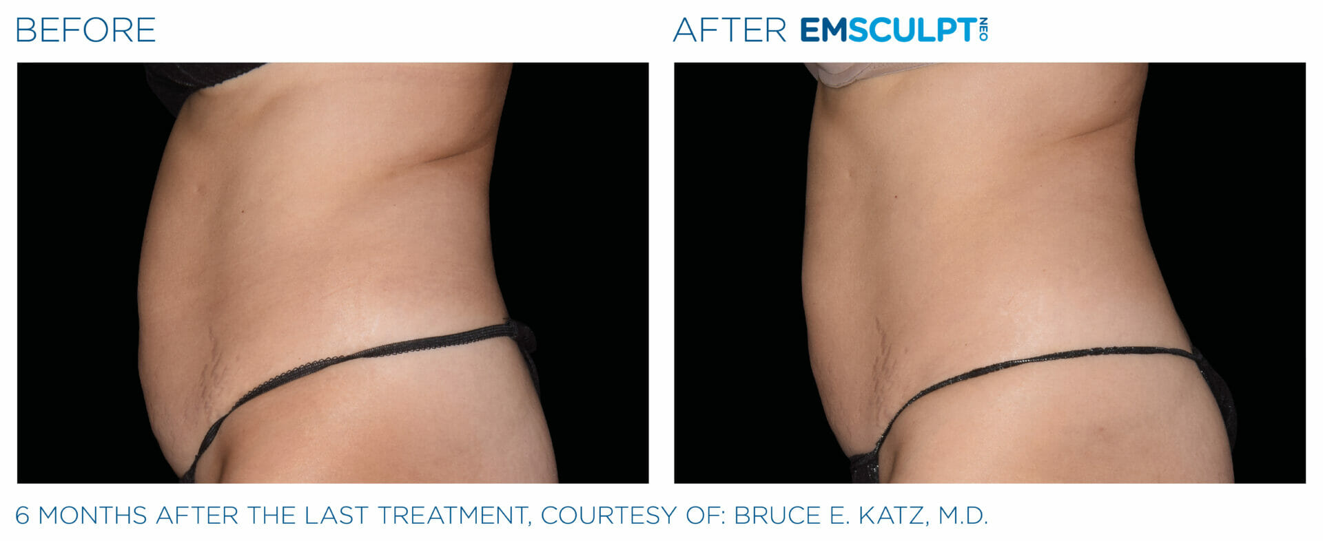 Emsculpt Neo Before & After Image