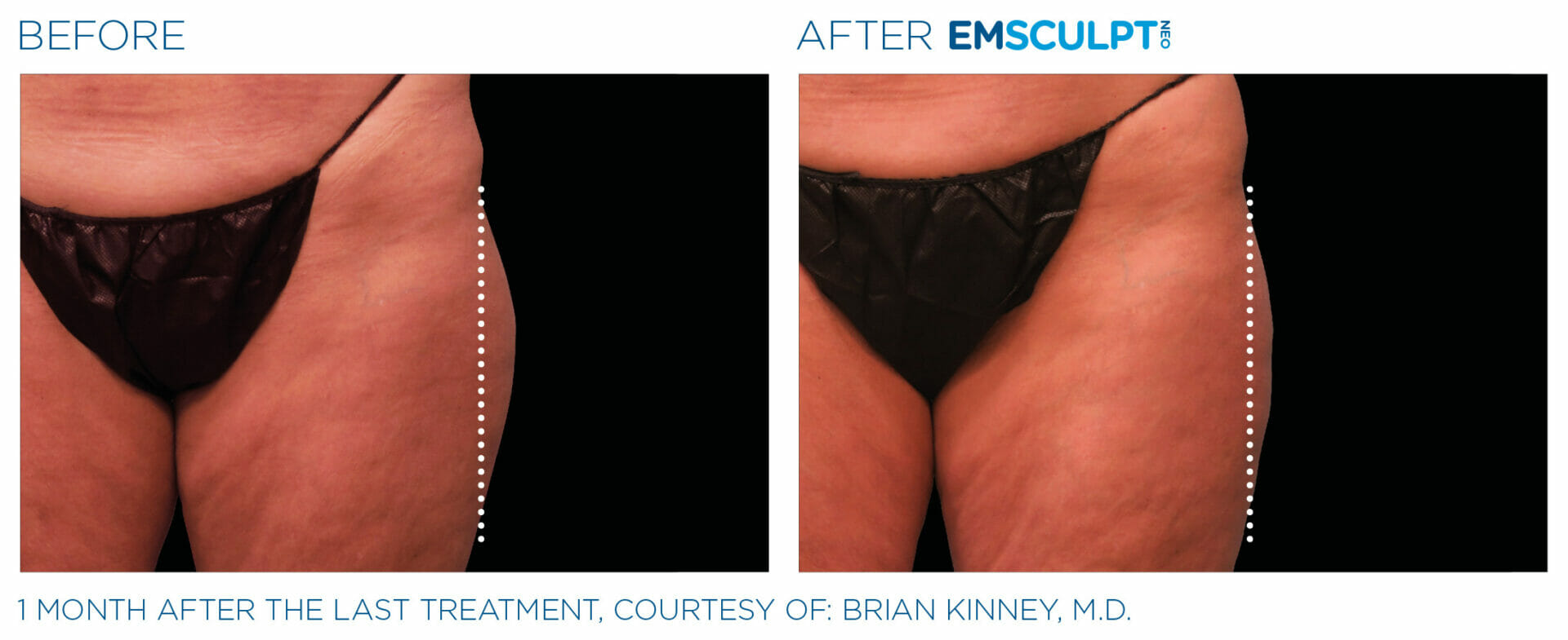 Emsculpt Neo Before & After Image